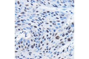 Immunohistochemistry of paraffin-embedded human esophageal cancer using NUDT21 Rabbit pAb (ABIN1681134, ABIN3018973, ABIN3018974 and ABIN6220652) at dilution of 1:100 (40x lens).