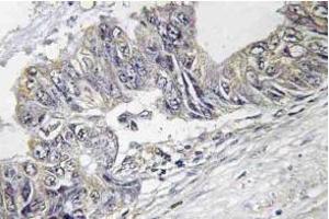 Immunohistochemistry (IHC) analyzes of p-JNK1/2/3 antibody in paraffin-embedded human colon carcinoma tissue. (JNK 抗体  (pThr183))