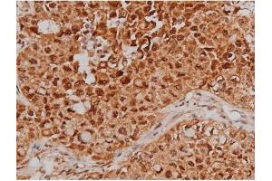 ABIN6267363 at 1/200 staining Human lung cancer tissue sections by IHC-P. (MAPT 抗体  (pSer262))