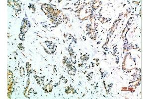 Immunohistochemical analysis of paraffin-embedded human-stomach-cancer, antibody was diluted at 1:200