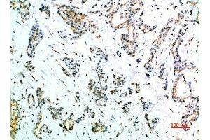 Immunohistochemical analysis of paraffin-embedded human-stomach-cancer, antibody was diluted at 1:200 (FCGR1A 抗体  (AA 230-280))