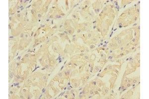Immunohistochemistry of paraffin-embedded human gastric cancer using ABIN7147210 at dilution of 1:100 (CDC42EP2 抗体  (AA 9-210))