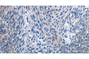 Immunohistochemistry of paraffin-embedded Human cervical cancer using IL2RB Polyclonal Antibody at dilution of 1:30 (IL2 Receptor beta 抗体)