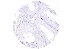 Adenocarcinoma of the colon with low content of CD163 positive macrophages (CD163 抗体  (AA 43-196))