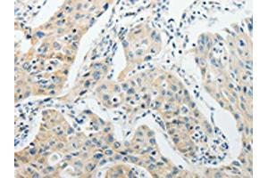 The image on the left is immunohistochemistry of paraffin-embedded Human lung cancer tissue using ABIN7189714(AGBL1 Antibody) at dilution 1/15, on the right is treated with synthetic peptide. (AGBL1 抗体)