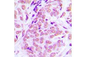 Immunohistochemical analysis of NFIA staining in human breast cancer formalin fixed paraffin embedded tissue section. (NFIA 抗体  (N-Term))
