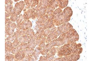 Formalin-fixed, paraffin-embedded human Basal Cell Carcinoma stained with EpCAM Rabbit Recombinant Monoclonal Antibody (EGP40/2041R). (Recombinant EpCAM 抗体  (Extracellular Domain))
