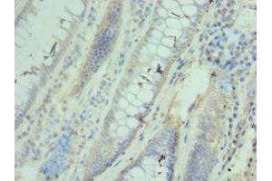 Immunohistochemistry of paraffin-embedded human colon cancer using ABIN7171427 at dilution of 1:100 (CCT3 抗体  (AA 1-300))