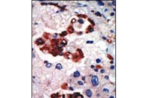 Formalin-fixed and paraffin-embedded human cancer tissue reacted with the primary antibody, which was peroxidase-conjugated to the secondary antibody, followed by AEC staining. (PKC iota 抗体  (N-Term))