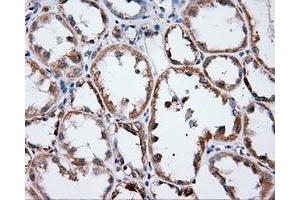 Immunohistochemical staining of paraffin-embedded Adenocarcinoma of ovary tissue using anti-ANXA1 mouse monoclonal antibody. (Annexin a1 抗体)