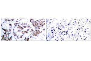 Immunohistochemical analysis of paraffin-embedded human breast carcinoma tissue, using MEF2A (phospho-Thr312) antibody (E011039). (MEF2A 抗体  (pThr312))