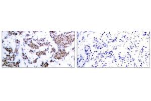 Immunohistochemical analysis of paraffin-embedded human breast carcinoma tissue, using MEF2A (phospho-Thr312) antibody (E011039). (MEF2A 抗体  (pThr312))