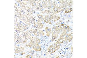 Immunohistochemistry of paraffin-embedded human liver cancer using Haptoglobin (Haptoglobin (HP)) antibody (ABIN3022157, ABIN3022158, ABIN1513029, ABIN1514188 and ABIN6218636) at dilution of 1:100 (40x lens). (Haptoglobin 抗体)