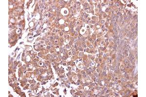 IHC-P Image Mucin 4 antibody detects Mucin 4 protein at cytosol on human breast carcinoma by immunohistochemical analysis. (MUC4 抗体)