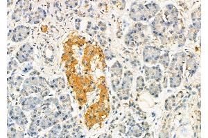 ABIN6260353 and ABIN6277507 at 1/100 staining Human pancreatic cancer and adjacent nomal tissues by IHC-P. (C10orf2 抗体  (C-Term))