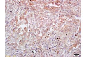 Formalin-fixed and paraffin embedded human lung carcinoma labeled with Rabbit Anti Trk A/B/C Polyclonal Antibody, Unconjugated (ABIN726095) at 1:200 followed by conjugation to the secondary antibody and DAB staining (TrkA, B, C (AA 668-750) 抗体)
