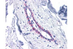 Immunohistochemistry (IHC) image for anti-Cadherin 1, Type 1, E-Cadherin (Epithelial) (CDH1) (Middle Region) antibody (ABIN2784498) (E-cadherin 抗体  (Middle Region))