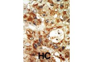 Formalin-fixed and paraffin-embedded human hepatocellular carcinoma tissue reacted with MAPK12 polyclonal antibody  , which was peroxidase-conjugated to the secondary antibody, followed by AEC staining. (MAPK12 抗体  (Internal Region))