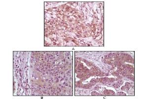 Immunohistochemical analysis of paraffin-embedded human pancreas carcinoma (A), esophagus carcinoma tissue (B) and ovary tumor tissue (C), showing cytoplasmic and membrane localization using 4E-BP1 antibody with DAB staining. (eIF4EBP1 抗体)