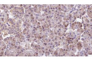 ABIN6273233 at 1/100 staining Human pancreas cancer tissue by IHC-P. (DYNC2LI1 抗体  (Internal Region))