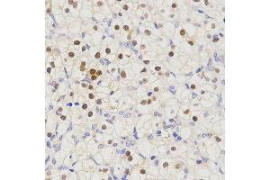 Immunohistochemistry of paraffin-embedded human kidney cancer tissue using SCTR antibody at dilution of 1:200 (x400 lens) (SCTR 抗体)