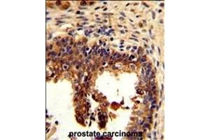 Formalin-fixed and paraffin-embedded human prostate carcinoma reacted with KRT4 Antibody (C-term), which was peroxidase-conjugated to the secondary antibody, followed by DAB staining. (KRT4 抗体  (C-Term))