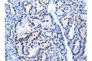 The image on the left is immunohistochemistry of paraffin-embedded Human thyroid cancer tissue using ABIN7191961(POU2AF1 Antibody) at dilution 1/15, on the right is treated with synthetic peptide. (POU2AF1 抗体)