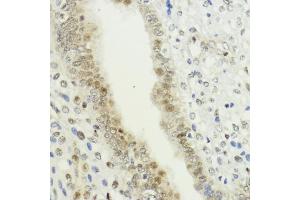 Immunohistochemistry of paraffin-embedded human uterine cancer using LDB1 antibody (ABIN7268255) at dilution of 1:200 (40x lens). (LIM Domain Binding 1 Protein 抗体  (AA 1-50))