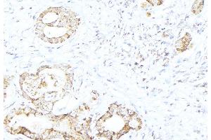 ABIN6268921 at 1/100 staining Human lung cancer tissue by IHC-P. (HSPD1 抗体)