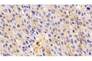 Detection of ORM2 in Human Liver cancer Tissue using Polyclonal Antibody to Orosomucoid 2 (ORM2) (Orosomucoid 2 抗体)