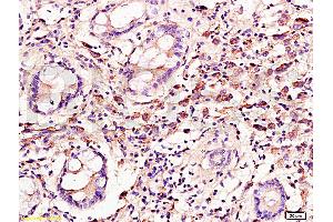 Formalin-fixed and paraffin embedded: human colon carcinoma labeled with Anti-Cyclin C Polyclonal Antibody, Unconjugated (ABIN727250) at 1:300, followed by conjugation to the secondary antibody and DAB staining (Cyclin C 抗体  (AA 23-100))