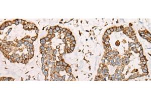 Immunohistochemistry of paraffin-embedded Human esophagus cancer tissue using CAPN9 Polyclonal Antibody at dilution of 1:45(x200) (Calpain 9 抗体)