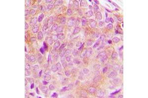 Immunohistochemical analysis of PLC gamma 2 staining in human breast cancer formalin fixed paraffin embedded tissue section. (Phospholipase C gamma 2 抗体  (C-Term))