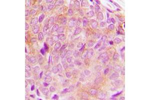 Immunohistochemical analysis of PLC gamma 2 staining in human breast cancer formalin fixed paraffin embedded tissue section.
