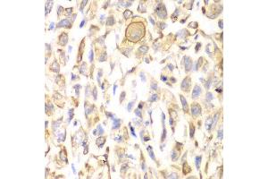 Immunohistochemistry of paraffin-embedded human lung cancer using CD151 antibody at dilution of 1:200 (400x lens). (CD151 抗体)