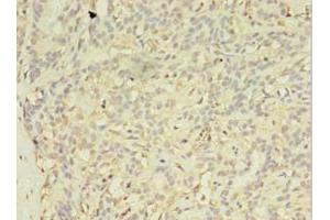 Immunohistochemistry of paraffin-embedded human breast cancer using ABIN7152293 at dilution of 1:100 (EXOSC5 抗体  (AA 1-235))