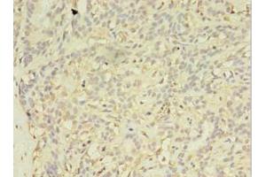 Immunohistochemistry of paraffin-embedded human breast cancer using ABIN7152293 at dilution of 1:100 (EXOSC5 抗体  (AA 1-235))