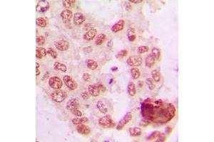 Immunohistochemical analysis of GRK5 staining in human lung cancer formalin fixed paraffin embedded tissue section. (GRK5 抗体  (Center))