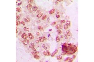 Immunohistochemical analysis of GRK5 staining in human lung cancer formalin fixed paraffin embedded tissue section.