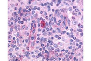 Anti-CD97 antibody IHC of human Lymph Node, Hodgkins Lymphoma. (CD97 抗体  (N-Term))