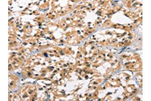 The image on the left is immunohistochemistry of paraffin-embedded Human thyroid cancer tissue using ABIN7190849(GPR182 Antibody) at dilution 1/30, on the right is treated with synthetic peptide. (G Protein-Coupled Receptor 182 抗体)