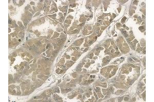 ABIN6258306 and ABIN6274290 at 1/100 staining human renal cell carcinoma by IHC-P. (PTTG1 抗体  (C-Term))