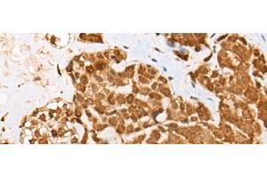 Immunohistochemistry of paraffin-embedded Human thyroid cancer tissue using ATN1 Polyclonal Antibody at dilution of 1:50(x200) (Atrophin 1 抗体)