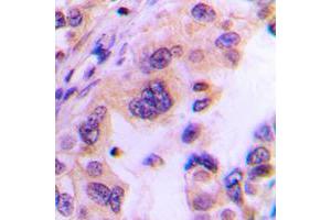 Immunohistochemical analysis of Translin staining in human lung cancer formalin fixed paraffin embedded tissue section. (Translin 抗体  (Center))