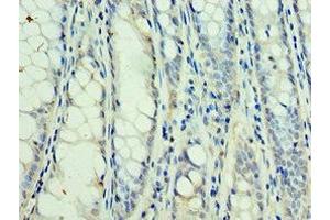 Immunohistochemistry of paraffin-embedded human colon cancer using ABIN7169764 at dilution of 1:100 (SSNA1 抗体  (AA 1-119))