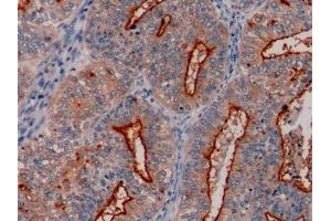 Detection of MUC1 in Human Endometrial cancer Tissue using Polyclonal Antibody to Mucin 1 (MUC1) (MUC1 抗体  (AA 1034-1151))