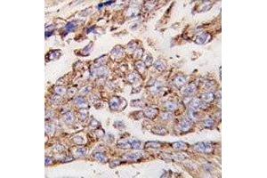 IHC analysis of FFPE human lung carcinoma tissue stained with LAMP1 antibody (LAMP1 抗体  (AA 125-154))
