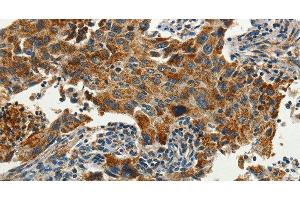 Immunohistochemistry of paraffin-embedded Human lung cancer using SERPINA9 Polyclonal Antibody at dilution of 1:60 (SERPINA9 抗体)