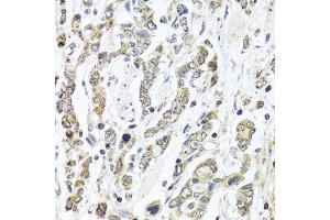 Immunohistochemistry of paraffin-embedded human gastric cancer using IFNL3 antibody (ABIN6293714) at dilution of 1:100 (40x lens). (IL28B 抗体)