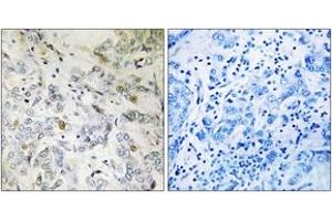 Immunohistochemistry analysis of paraffin-embedded human breast carcinoma tissue, using HCC1 Antibody.